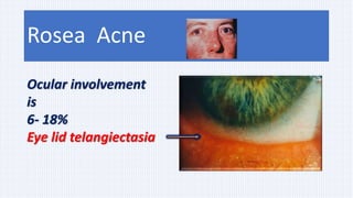 Rosea Acne
Ocular involvement
is
6- 18%
Eye lid telangiectasia
 