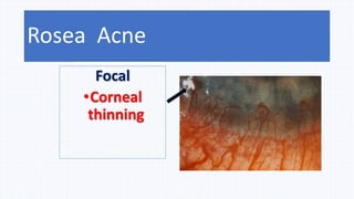 2. Marginal keratitis –
in Rosea with peripheral vascularization
Focal
•Corneal
thinning
Ocular involvement – 6-18%
Rosea Acne
 
