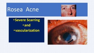 2. Marginal keratitis –
in Rosea with peripheral vascularization
•Severe Scarring
•and
•vascularization
Ocular involvement – 6-18%
Rosea Acne
 