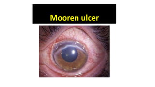 Mooren ulcer
 