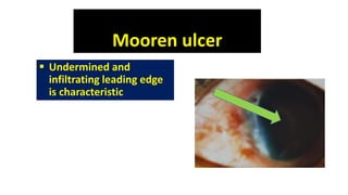 Mooren ulcer
 Undermined and
infiltrating leading edge
is characteristic
 
