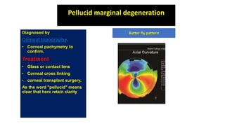 Pellucid marginal degeneration
Diagnosed by
Corneal topography.
• Corneal pachymetry to
confirm.
Treatment
• Glass or contact lens
• Corneal cross linking
• corneal transplant surgery.
As the word "pellucid" means
clear that here retain clarity
Butter fly pattern
 