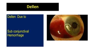Dellen
Dellen Due to
Sub conjunctival
Hemorrhage
 