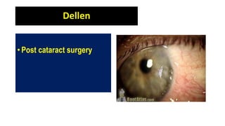 Dellen
• Post cataract surgery
 