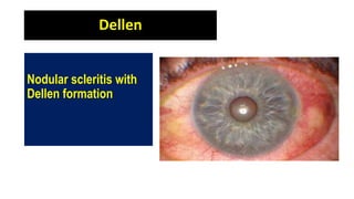 Dellen
Nodular scleritis with
Dellen formation
 