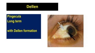 Dellen
Pingecula
Long term
with Dellen formation
 