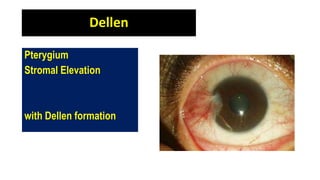 Dellen
Pterygium
Stromal Elevation
with Dellen formation
 