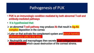 Pathogenesis of PUK
• PUK is an immunologic condition mediated by both abnormal T-cell and
antibody-mediated pathways
• It is hypothesized that:
 an abnormal T-cell pathway may produce Ab that result in Ag-Ab
complex deposition in the cornea
Later on that activate the complement system and recruit harmful
inflammatory cells to the area.
 Neutrophils and macrophages then secrete local collagenases and
other proteases which cause destruction of the corneal stroma.
 