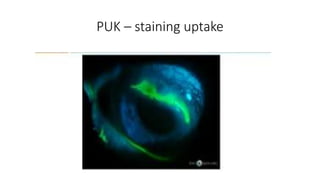 PUK – staining uptake
 