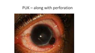 PUK – along with perforation
 