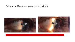 Mrs xxx Devi – seen on 23.4.22
Peripheral Epithelial defect Associated with vascularization and anterior uvitis
 