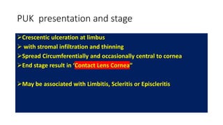 PUK presentation and stage
Crescentic ulceration at limbus
 with stromal infiltration and thinning
Spread Circumferentially and occasionally central to cornea
End stage result in ‘Contact Lens Cornea”
May be associated with Limbitis, Scleritis or Episcleritis
 