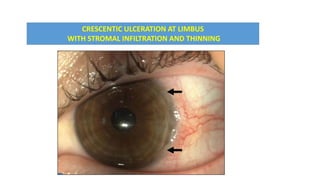 CRESCENTIC ULCERATION AT LIMBUS
WITH STROMAL INFILTRATION AND THINNING
 