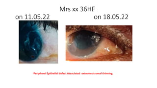 Mrs xx 36HF
on 11.05.22 on 18.05.22
Peripheral Epithelial defect Associated extreme stromal thinning
 