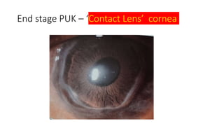 End stage PUK – ‘Contact Lens’ cornea
 