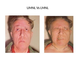 Comprehensive Overview of Peripheral Facial Nerve Paralysis: Anatomy ...