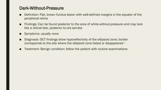 Dark-Without-Pressure
■ Definition: Flat, brown fundus lesion with well-defined margins in the equator of the
peripheral retina
■ Findings: Can be found posterior to the area of white-without-pressure and may look
like a retinal tear, posterior to ora serrata
■ Symptoms: usually none
■ Diagnosis: OCT findings show hyporeflectivity of the ellipsoid zone; border
corresponds to the site where the ellipsoid zone faded or disappeared[4]
■ Treatment: Benign condition; follow the patient with routine examinations
 