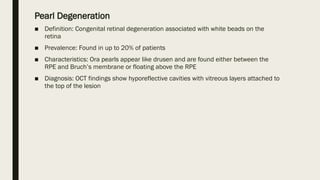 Pearl Degeneration
■ Definition: Congenital retinal degeneration associated with white beads on the
retina
■ Prevalence: Found in up to 20% of patients
■ Characteristics: Ora pearls appear like drusen and are found either between the
RPE and Bruch’s membrane or floating above the RPE
■ Diagnosis: OCT findings show hyporeflective cavities with vitreous layers attached to
the top of the lesion
 