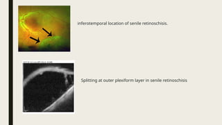 inferotemporal location of senile retinoschisis.
Splitting at outer plexiform layer in senile retinoschisis
 