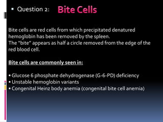  Question 2:
Bite cells are red cells from which precipitated denatured
hemoglobin has been removed by the spleen.
The “bite” appears as half a circle removed from the edge of the
red blood cell.
Bite cells are commonly seen in:
• Glucose 6 phosphate dehydrogenase (G-6-PD) deficiency
• Unstable hemoglobin variants
• Congenital Heinz body anemia (congenital bite cell anemia)
 