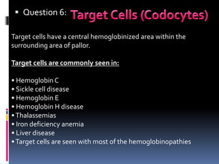  Question 6:
Target cells have a central hemoglobinized area within the
surrounding area of pallor.
Target cells are commonly seen in:
• Hemoglobin C
• Sickle cell disease
• Hemoglobin E
• Hemoglobin H disease
•Thalassemias
• Iron deficiency anemia
• Liver disease
•Target cells are seen with most of the hemoglobinopathies
 