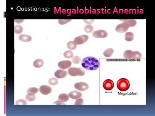  Question 15:
Megaloblast
 