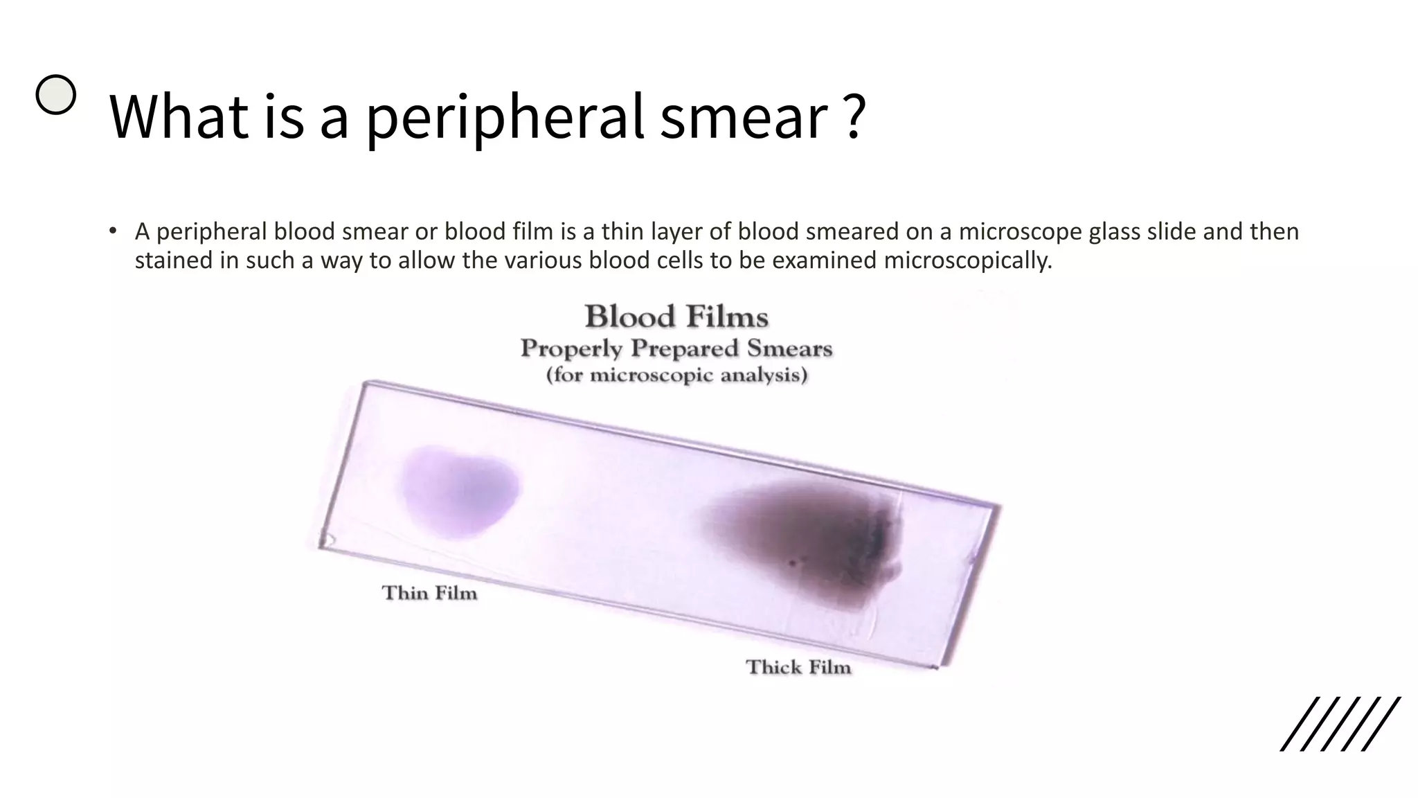 Peripheral smear staining and morphology | PDF | Blood Disorders ...
