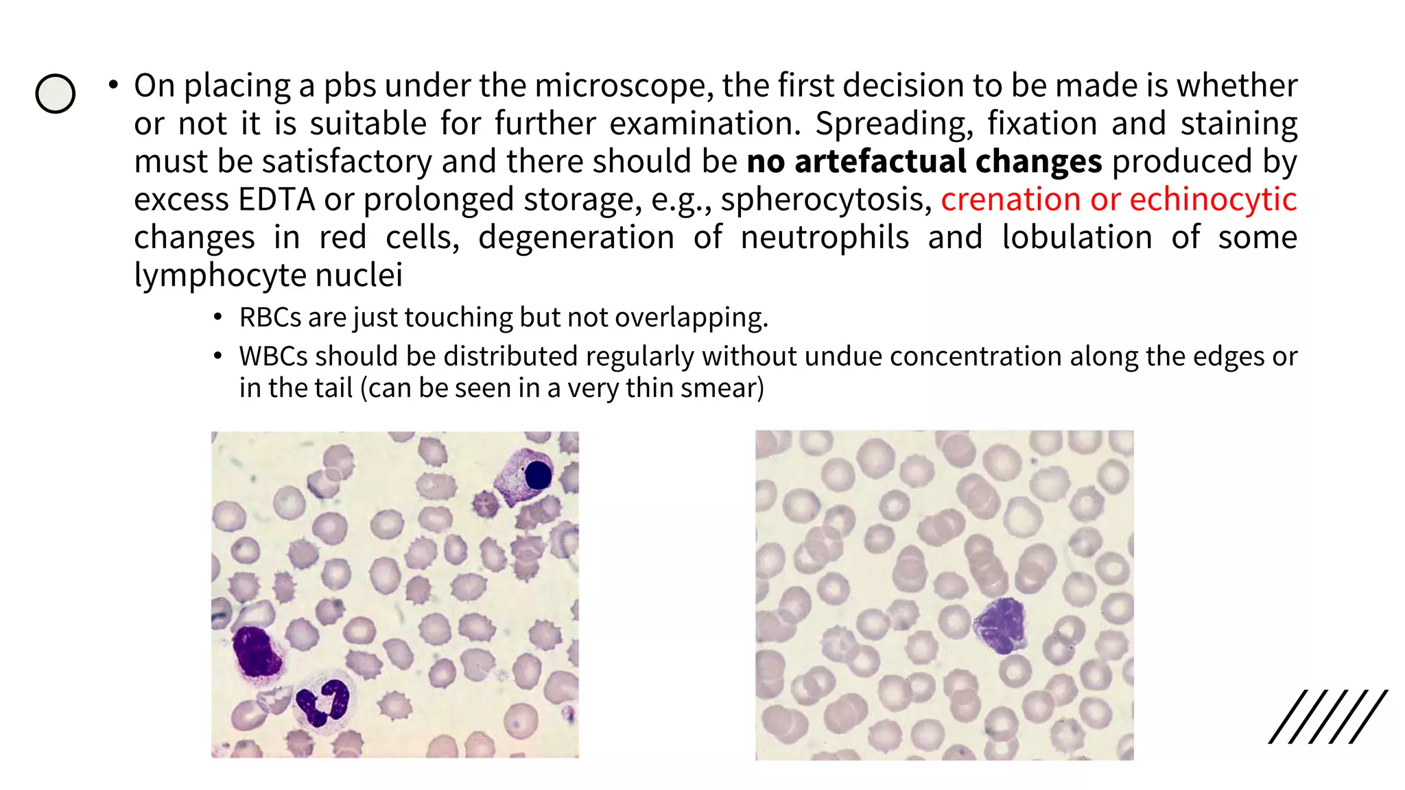 Peripheral smear staining and morphology | PDF | Blood Disorders ...