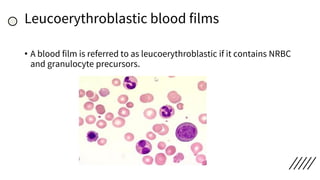 Leucoerythroblastic blood films
• A blood film is referred to as leucoerythroblastic if it contains NRBC
and granulocyte precursors.
 