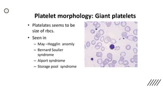 Platelet morphology: Giant platelets
• Platelates seems to be
size of rbcs.
• Seen in
– May –Hegglin anomly
– Bernard Soulier
syndrome
– Alport syndrome
– Storage pool syndrome
 