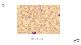 Platelet clumping
 
