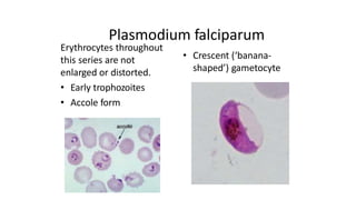 Plasmodium falciparum
Erythrocytes throughout
this series are not
enlarged or distorted.
• Early trophozoites
• Accole form
• Crescent (‘banana-
shaped’) gametocyte
 