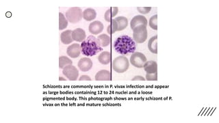 Schizonts are commonly seen in P. vivax infection and appear
as large bodies containing 12 to 24 nuclei and a loose
pigmented body. This photograph shows an early schizont of P.
vivax on the left and mature schizonts
 