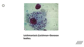 Leishmaniasis (Leishman–Donovan
bodies)
 