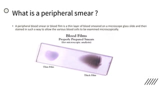 What is a peripheral smear ?
• A peripheral blood smear or blood film is a thin layer of blood smeared on a microscope glass slide and then
stained in such a way to allow the various blood cells to be examined microscopically.
 