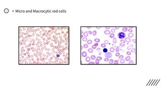 • Micro and Macrocytic red cells
 