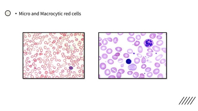 Peripheral smear staining and morphology | PDF | Blood Disorders ...