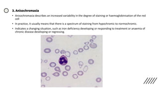 3. Anisochromasia
• Anisochromasia describes an increased variability in the degree of staining or haemoglobinisation of the red
cell
• In practice, it usually means that there is a spectrum of staining from hypochromic to normochromic.
• Indicates a changing situation, such as iron deficiency developing or responding to treatment or anaemia of
chronic disease developing or regressing.
 