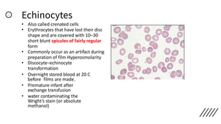 Echinocytes
• Also called crenated cells
• Erythrocytes that have lost their disc
shape and are covered with 10–30
short blunt spicules of fairly regular
form
• Commonly occur as an artifact during
preparation of film Hyperosmolarity
• Discocyte–echinocyte
transformation
• Overnight stored blood at 20 C
before films are made.
• Premature infant after
exchange transfusion
• water contaminating the
Wright’s stain (or absolute
methanol)
 