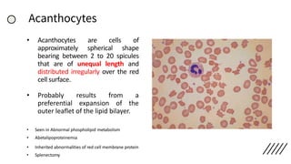 Acanthocytes
• Acanthocytes are cells of
approximately spherical shape
bearing between 2 to 20 spicules
that are of unequal length and
distributed irregularly over the red
cell surface.
• Probably results from a
preferential expansion of the
outer leaflet of the lipid bilayer.
• Seen in Abnormal phospholipid metabolism
• Abetalipoproteinemia
• Inherited abnormalities of red cell membrane protein
• Splenectomy
 