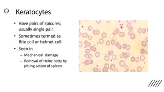 Keratocytes
• Have pairs of spicules;
usually single pair.
• Sometimes termed as
Bite cell or helmet cell
• Seen in
– Mechanical damage
– Removal of Heinz body by
pitting action of spleen.
 