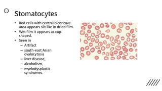 Stomatocytes
• Red cells with central biconcave
area appears slit like in dried film.
• Wet film it appears as cup-
shaped.
• Seen in
– Artifact
– south-east Asian
ovalocytosis
– liver disease,
– alcoholism,
– myelodysplastic
syndromes.
 