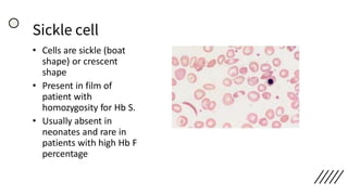 Sickle cell
• Cells are sickle (boat
shape) or crescent
shape
• Present in film of
patient with
homozygosity for Hb S.
• Usually absent in
neonates and rare in
patients with high Hb F
percentage
 
