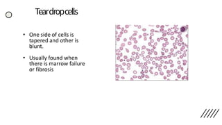 Teardropcells
• One side of cells is
tapered and other is
blunt.
• Usually found when
there is marrow failure
or fibrosis
 