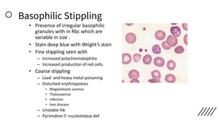 Basophilic Stippling
• Presence of irregular basophilic
granules with in Rbc which are
variable in size .
• Stain deep blue with Wright’s stain
• Fine stippling seen with
– Increased polychromatophilia
– Increased production of red cells.
• Coarse stippling
– Lead and heavy metal poisoning
– Disturbed erythropoiesis
• Megaloblastic anemia
• Thalassaemia
• infection
• liver disease
– Unstable Hb
– Pyrimidine-5’-nucleotidase def.
 