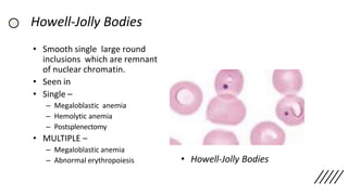 Howell-Jolly Bodies
• Smooth single large round
inclusions which are remnant
of nuclear chromatin.
• Seen in
• Single –
– Megaloblastic anemia
– Hemolytic anemia
– Postsplenectomy
• MULTIPLE –
– Megaloblastic anemia
– Abnormal erythropoiesis • Howell-Jolly Bodies
 