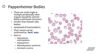 Pappenheimer Bodies
• These are small single or
multiple peripherally sited
angular basophilic (almost
black) erythrocyte inclusions.
• Smaller than Howell–Jolly
bodies.
• composed of haemosiderin.
• Their nature can be
confirmed by Perls’ stain.
• Seen in
– Sideroblastic
erythropoiesis
– Hypospenism
– Myelodysplastic syndrome
– Hemolytic anemia
 