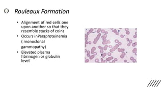 Rouleaux Formation
• Alignment of red cells one
upon another so that they
resemble stacks of coins.
• Occurs inParaproteinemia
( monoclonal
gammopathy)
• Elevated plasma
fibrinogen or globulin
level
 