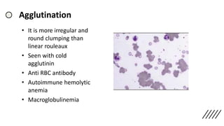 Agglutination
• It is more irregular and
round clumping than
linear rouleaux
• Seen with cold
agglutinin
• Anti RBC antibody
• Autoimmune hemolytic
anemia
• Macroglobulinemia
 