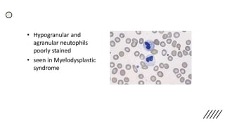 • Hypogranular and
agranular neutophils
poorly stained
• seen in Myelodysplastic
syndrome
 
